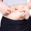 Liposuction