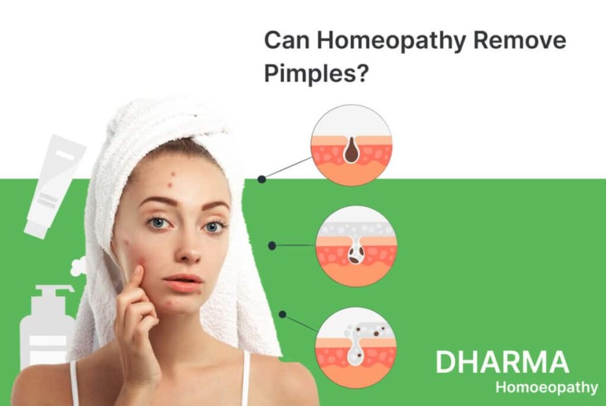 Say Goodbye to Acne with Homeopathy Treatment at Dharma Homoeopathy