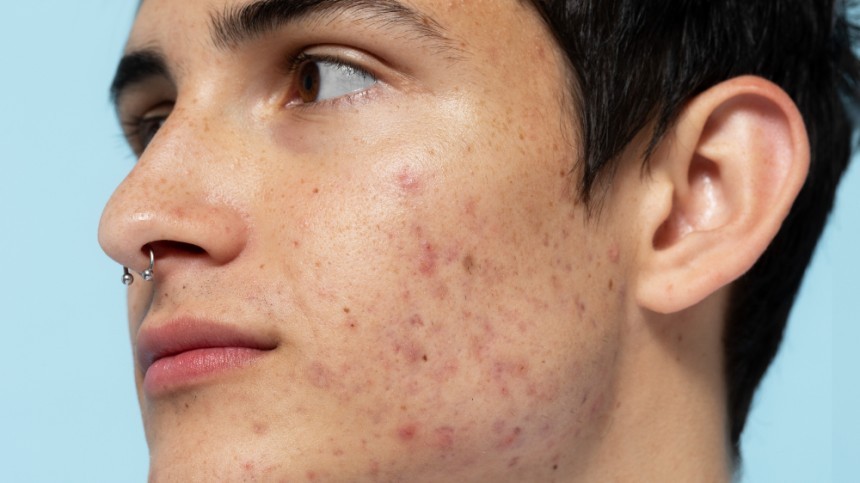 Discover Homeopathy Solutions for Acne at Dharma Homoeopathy