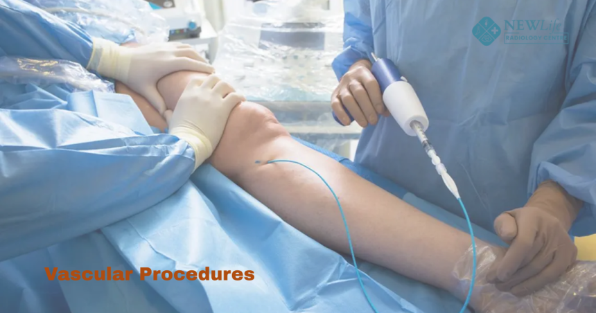 Vascular Procedures: A Simple Guide to Modern Treatments  By New Life Radiology Center