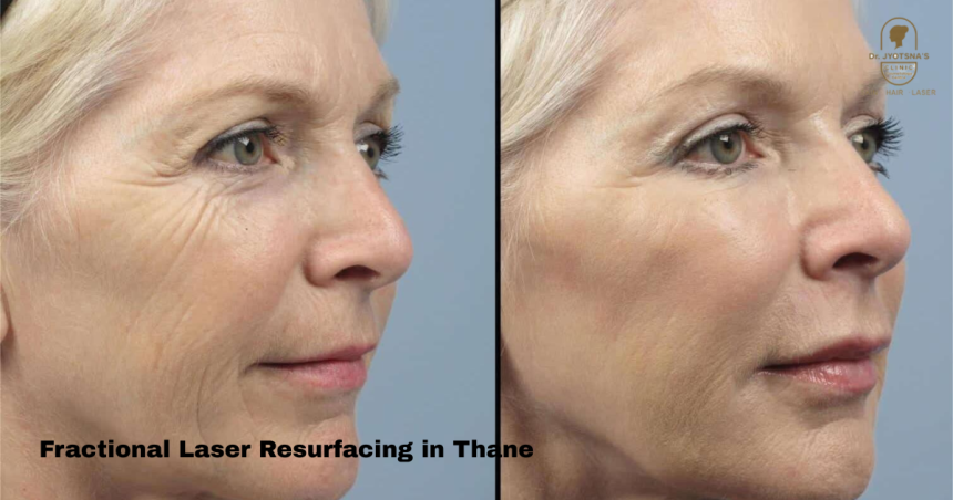 Refresh Your Skin Naturally with Fractional Laser Resurfacing in Thane  Give Your Skin a Clean Slate with Gentle Precision