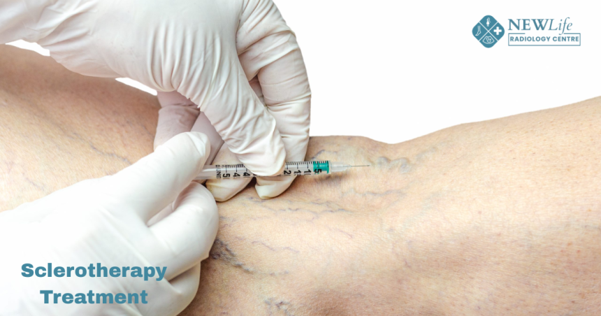 Goodbye to Bulging Veins: Sclerotherapy Treatment in Thane Explained