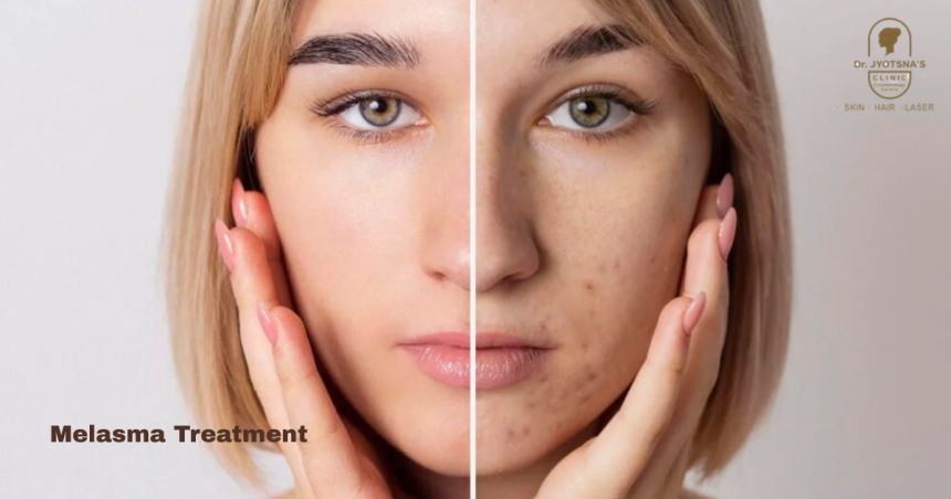 Top Clinic for Melasma Treatment in Thane – Clear Skin Awaits!
