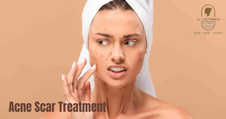 Acne Scar Treatment
