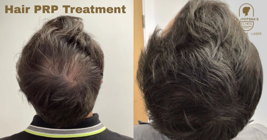 Hair PRP Treatment