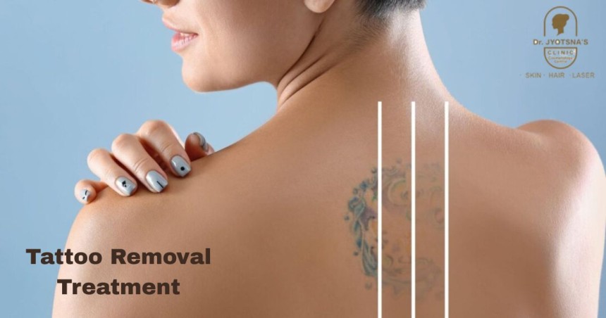 Tattoo Removal Treatment