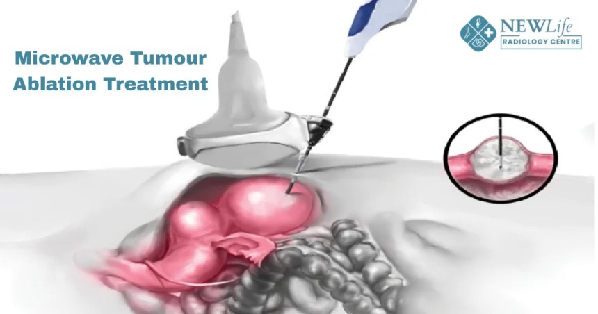Microwave Tumour Ablation Treatment in Thane – Step-by-Step Guide From Diagnosis to Recovery You Didn’t Expect