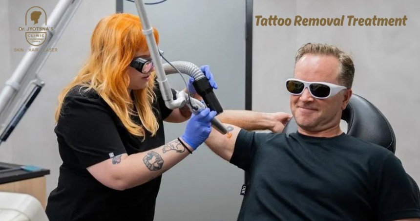 Tattoo Removal Treatment