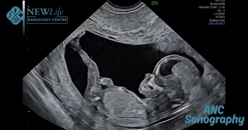 ANC Sonography